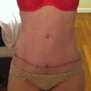 5 1/2 months post op. Showing my scar.