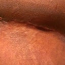 Right side, very swollen but spitting stitches have healed except for one tiny spot. Suture line looks amazing and will be even tighter once the swelling goes down! If all continues well no need for a revision and scar should be as nice as the left side!