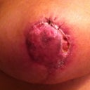 5 weeks post-op.  About 2 weeks since necrotic tissue removed.