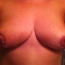 5 weeks post-op.