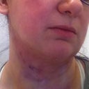 Jawline - 24 hours later