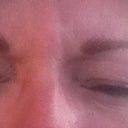The second day, again, trying to squeeze my brows and just cannot do it -
