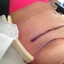 4 days post op