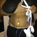 1 day post op