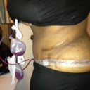 1 day post op side