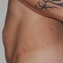 Side view pre op