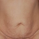 Front view Pre op