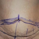 Markings before going into Surgery Feb 4 2011
