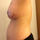 2 days post op left side view.
3/10/2012