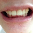 Second tray with no invisalign on, notice the deep bite