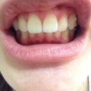 10th tray with no invisalign on. Improvement
