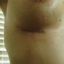 booby scar