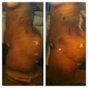 Swollen tummy post-op days 2 and post-op day 4.