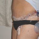 7 days post op