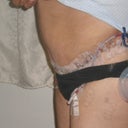 7 days post op
