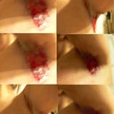 Arm openings after Dr. agah surgery