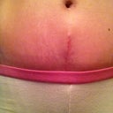 9 weeks PO and up close and personal with my newest scar.