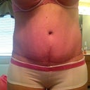Full frontal of my scar. I think it's really red still. Got my 100% aloe gel today. Lets see if it helps.