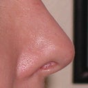 Rhinoplasty Surgery