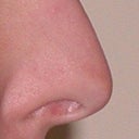 Rhinoplasty Surgery
