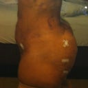 Swollen tummy post op 2