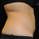 CoolSculpting Of The Lower Abdomen 