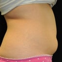 CoolSculpting Of The Lower Abdomen 