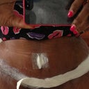 sneak peak, tummy tuck w/ lipo on the sides...no back lipo no bbl