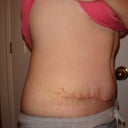 Incision was nice and low - will be easily hidden thankfully