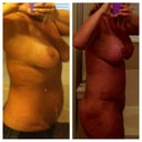 4 weeks post op SWELL HELL! I feel so fat