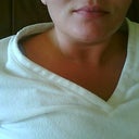about 7 months after lip augmentation