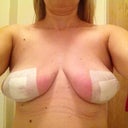 this photo was taken 2 hours after implants were removed 17/7/12