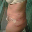 1 day post op