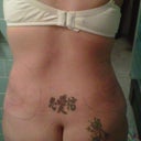 1 day post op