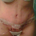 1 day post op