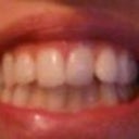 Before braces