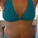 me in a bathing suit - before surgery