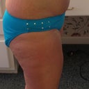 side view before surgery
