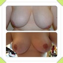 Before and after at 6 weeks, makes me shudder looking at the before!!
