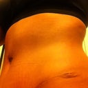 4 Weeks-Left Drain Site is healing nicely