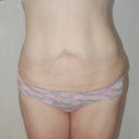 forward view. I have less skin than most 115 lb weight loss patients, likely because I lost mine over a 3 year period when i was relatively young.