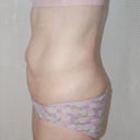 side view. My only significant amount of body fat is located on my lower and mid back. The stomach is mainly skin