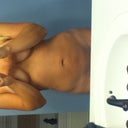 Week and a half after smartlipo