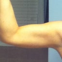 Week and a half after smartlipo