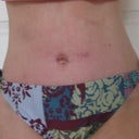 4 weeks post surgery
