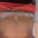Still have swelling on the side from lipo day 7