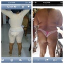back view day after surgery