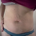 Front view, worried about how bad the stretch marks on the top of my bb will look after they are pulled down :/