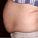 Before pic - The day of surgery