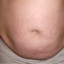 Before pic - The day of surgery